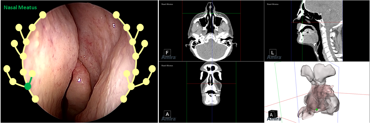Current position and navigation graphical hints are overlaid on the endoscopic video and visualized within an anatomical reference model and CT.