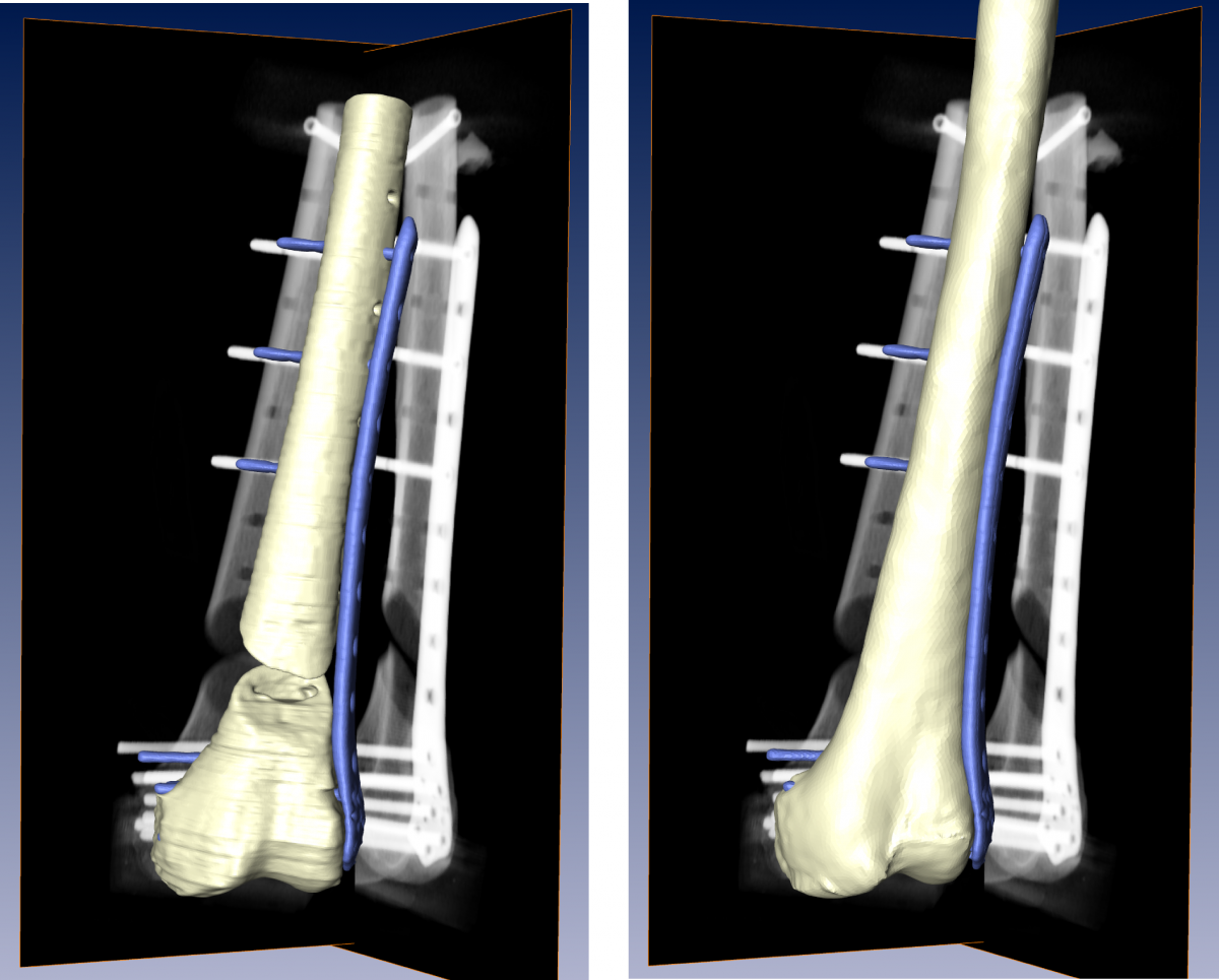Ground truth shape of the femur and implant from CT (left) and the 3D­-reconstructed femoral  shape and implant pose based on reference DRRs (right). 