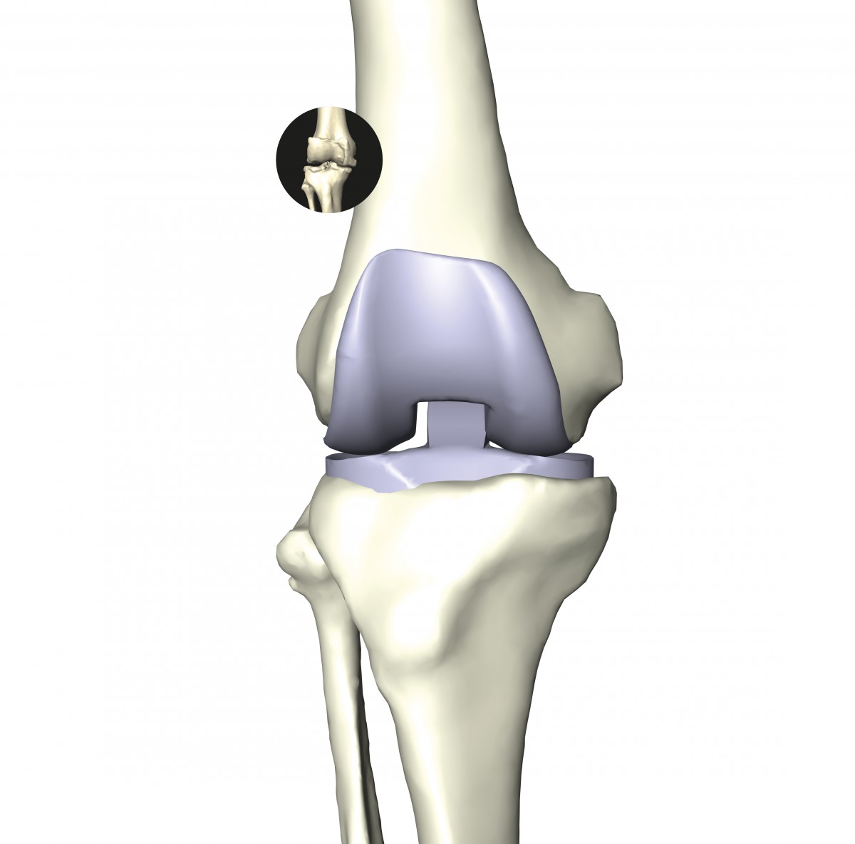 Individual anatomy reconstruction of the knee bones allows 3D planning of implant positioning. Mechanical simulations taking cartilage, patella, tendons, and ligaments into account improve the understanding of degenerative diseases and the functionally appropriate positioning of implants.