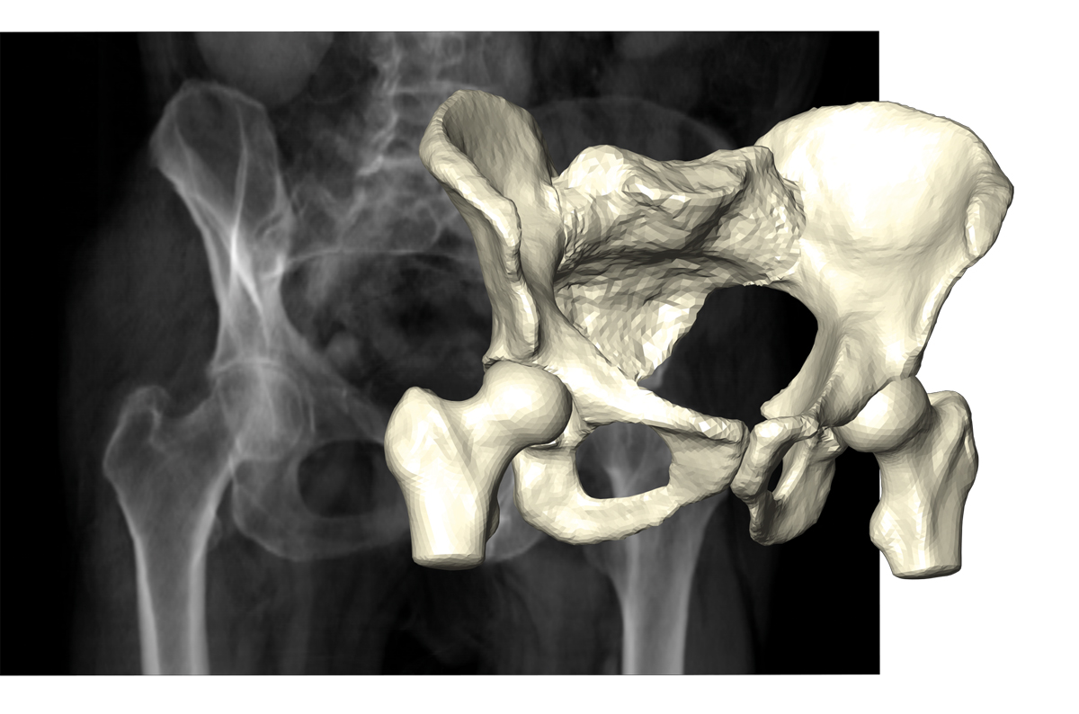 Reconstruction of pelvic bone and hip joints on the basis of few X-ray projections.
