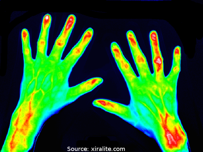 Fluoromath - Unsupervised Deep Learning to assess Hand Diseases
