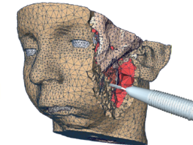 Computer-assisted and Model-guided Facial Surgery Planning
