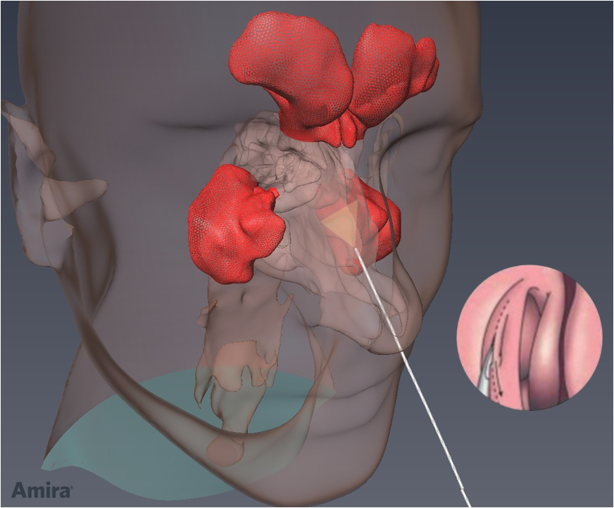 Endonasal endoscopic surgery