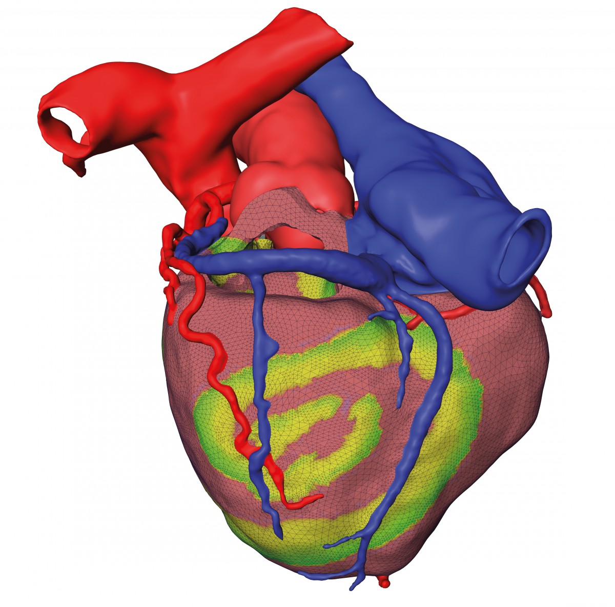 Changes in transmembrane voltage induce calcium release and myocard contraction. Simulation of the excitation fosters understanding of fibrillation onset and stability of spiral wave patterns, improving individual therapy planning.