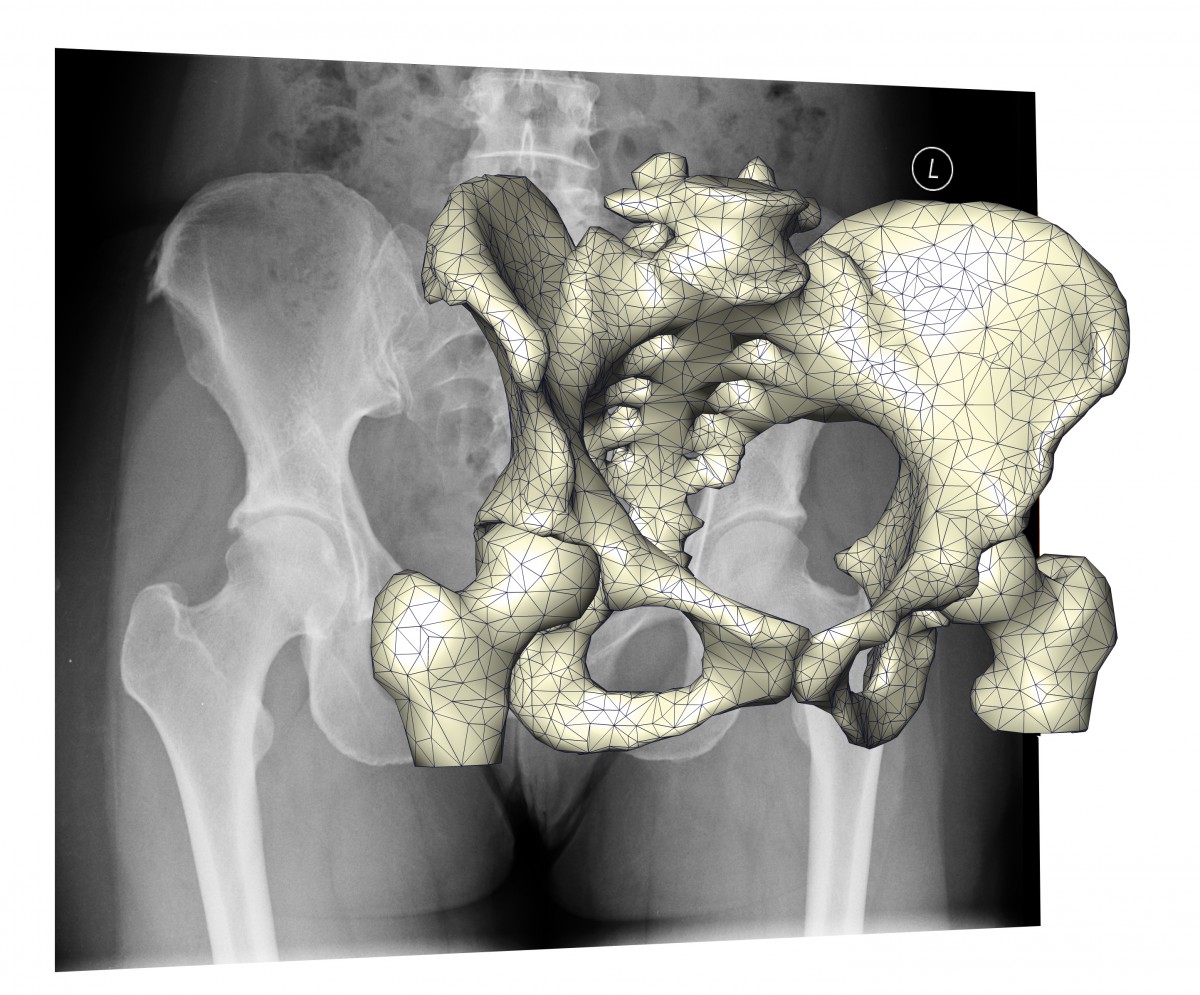 Comparing projections of shape models with actual X-ray images allows to estimate individual 3D geometry from few X-ray images, reducing the radiation dose compared to CT scans.