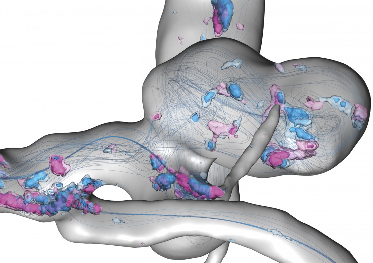 Uncertain flow features in a cerebral aneurysm within a full heart cycle: Depicted are streamlines of the simulated time-averaged blood velocity and spatial probabilities of critical points with Poincaré index > 0 and < 0 – visualized by blue and violet isosurfaces, respectively.