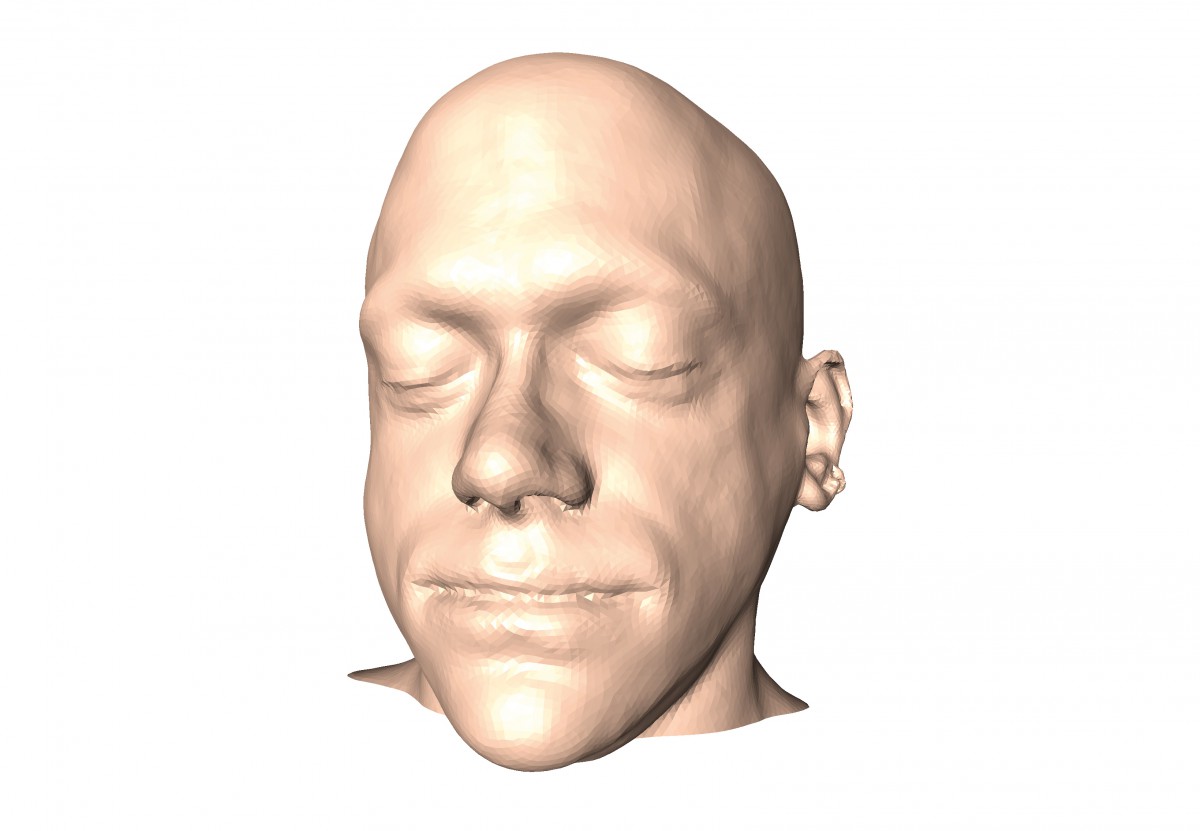 Augmentation implants replace traumatized bone or fill voids left by malformed bones. An important aspect is to restore a socially accepted facial shape, for which the appropriate implant shape has to be determined.