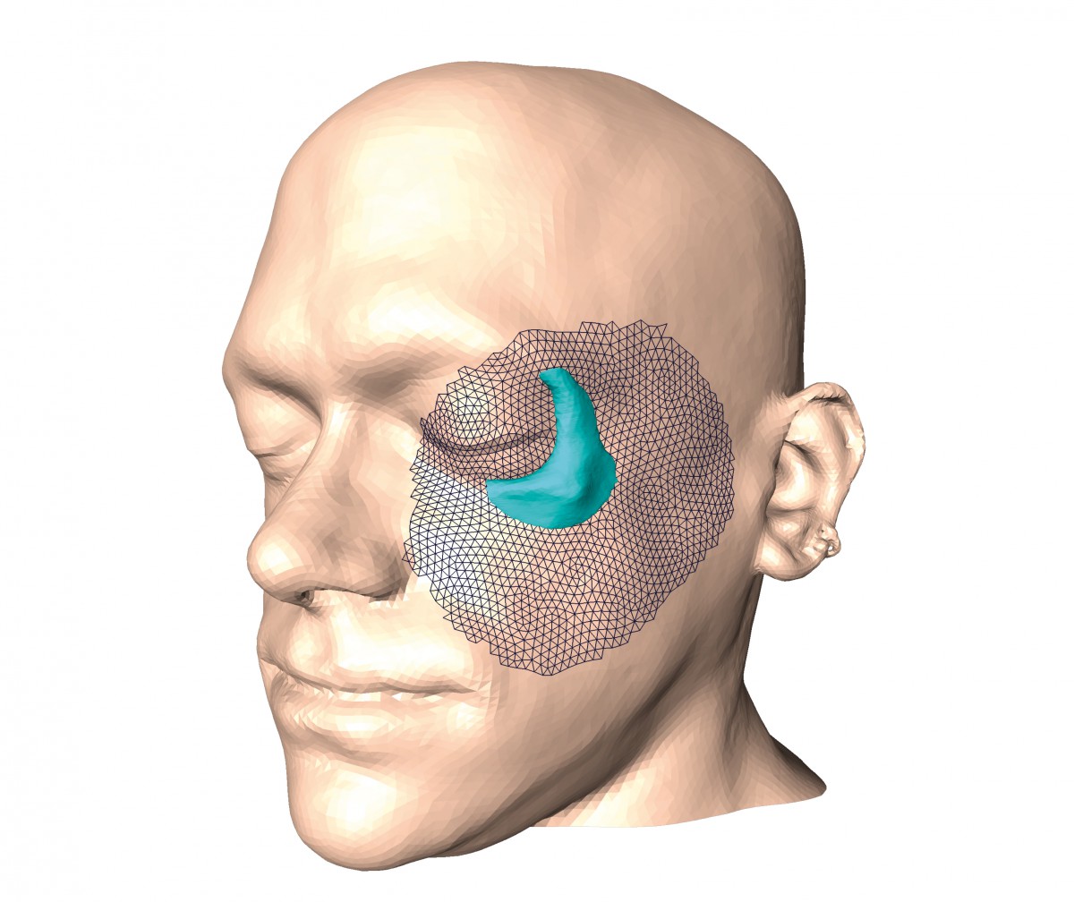 Augmentation implants replace traumatized bone or fill voids left by malformed bones. An important aspect is to restore a socially accepted facial shape, for which the appropriate implant shape has to be determined.