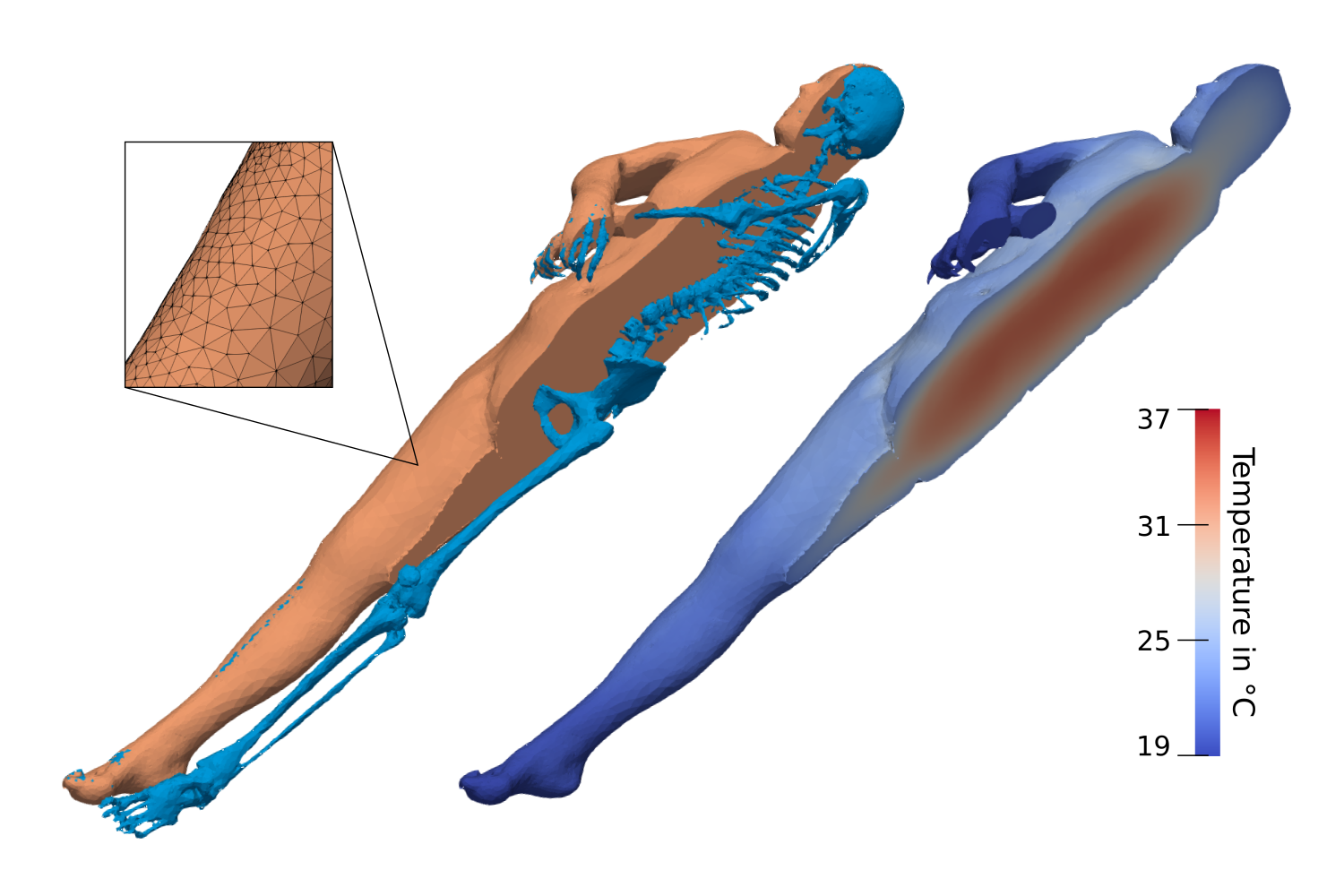 CT-generated body geometry as a tetrahedral grid with different tissue types (here using the example of bones) as well as FE simulation of cooling