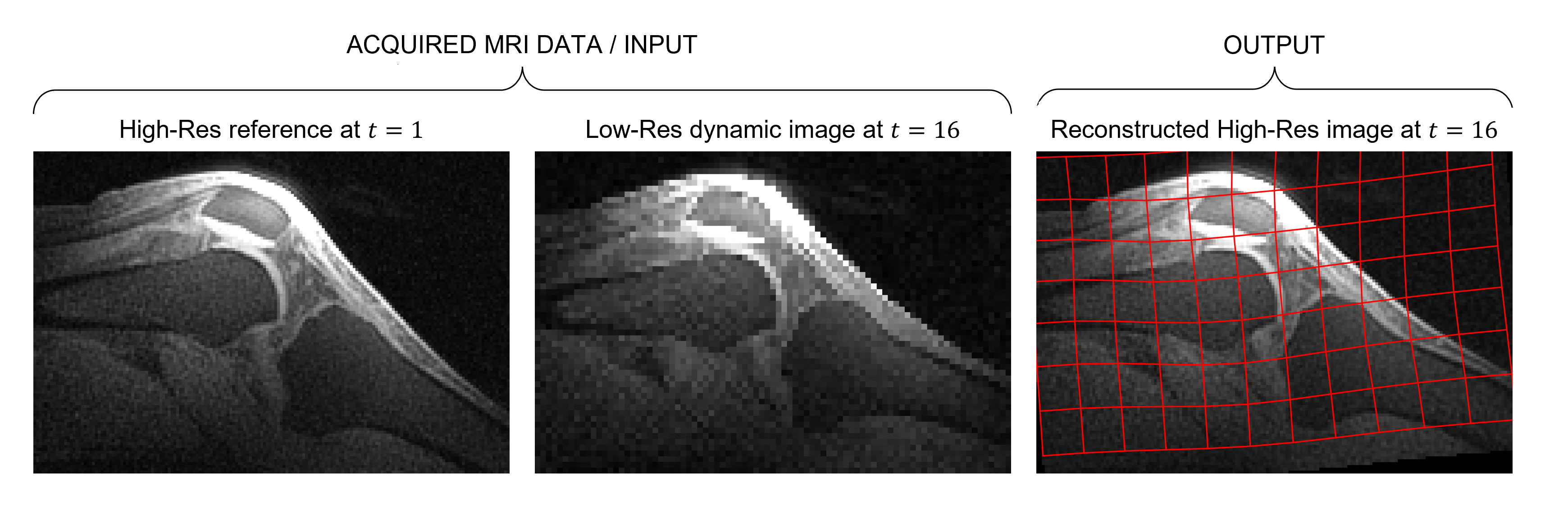 Acquired MRI knee data and its reconstruction. The reconstructed image is overlaid with a grid which represents how the HR reference image was deformed to align with corresponding LR dynamic time frame.
