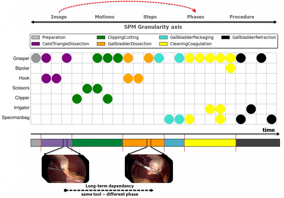 Surgical Phase Recognition