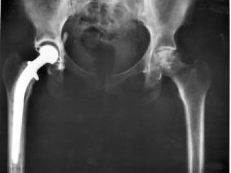 Adaptive Algorithms for Optimization of Hip Implant Positioning