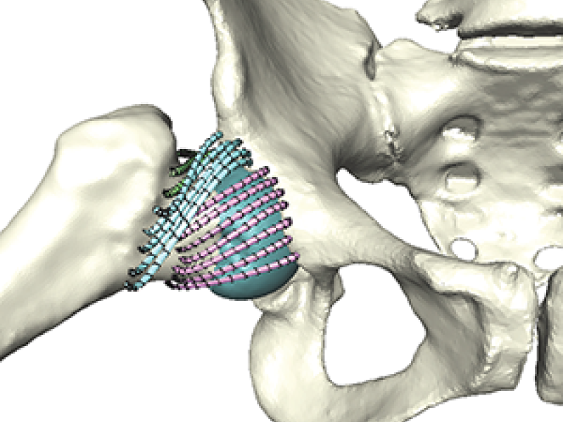 Reduced Basis Methods in Orthopedic Hip Surgery Planning