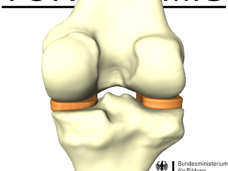 Treating Osteoarthritis in Knee with Mimicked Interpositional Spacer