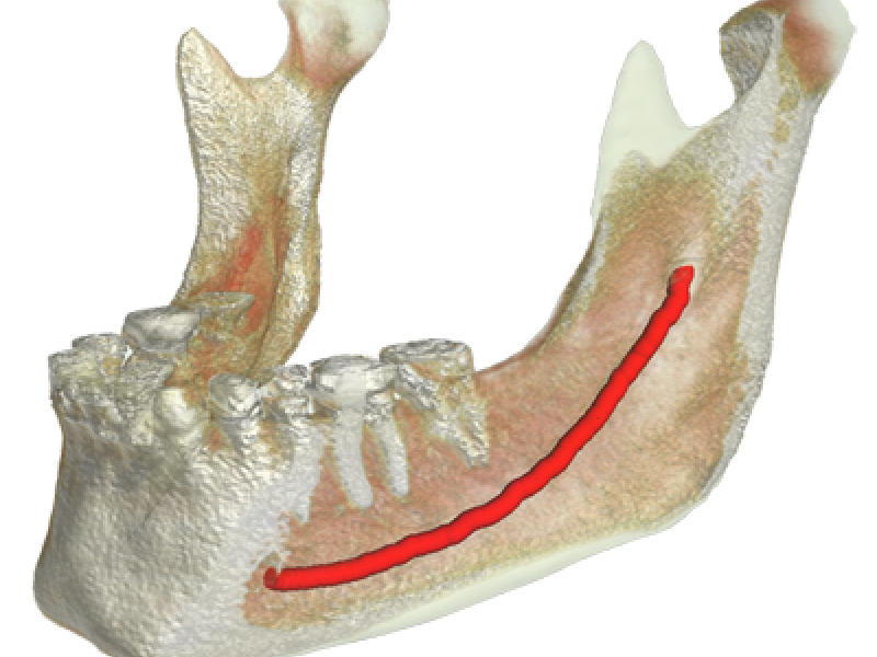 Surgery Planning for Dental Implantology