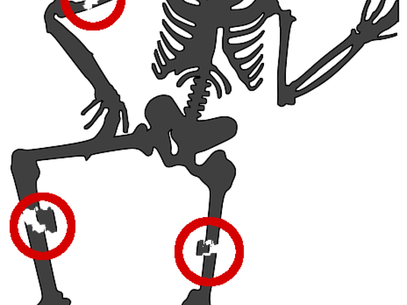 Osteosynthesis Follow-up from 2D X-rays