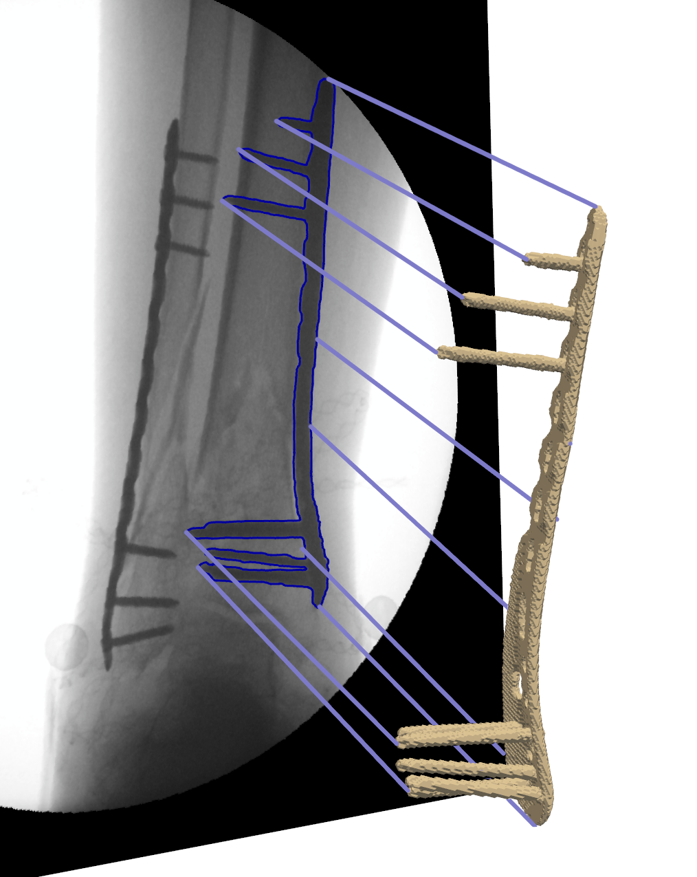 3D implant reconstruction from X-ray image